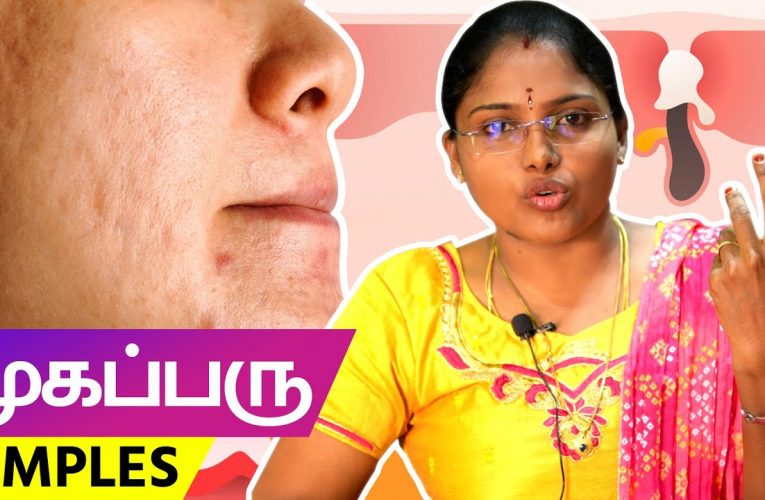 முகப்பரு தீர்வுகள் | Pimples remedy | Dr Vidhya | Aathichoodi